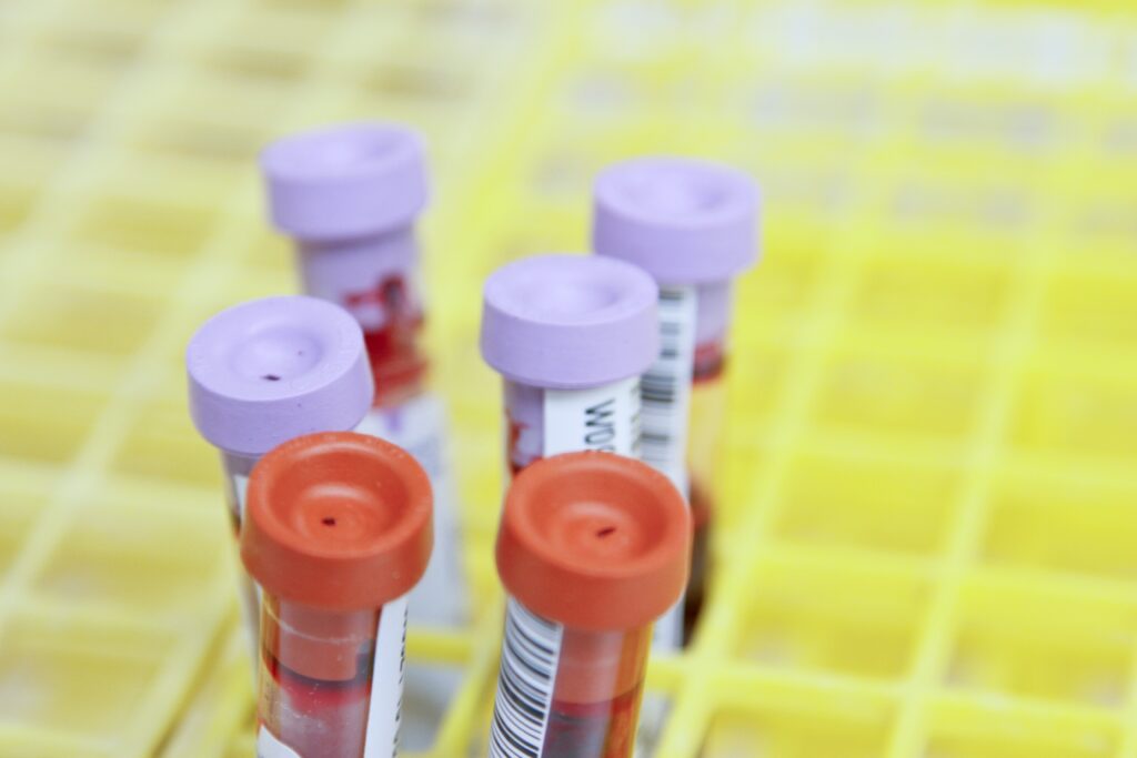 Western Blot Test Lyme