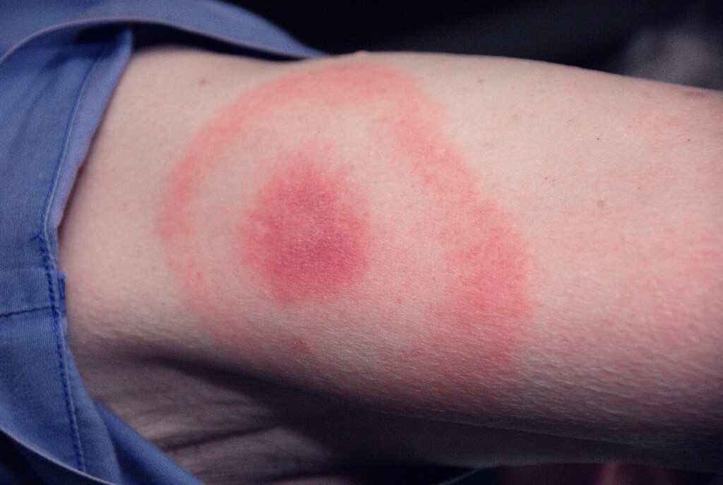 pictures of lyme disease rash