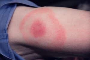 pictures of lyme disease rash