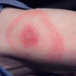 bullseye-lyme-disease-rash