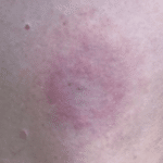 lyme disease rash