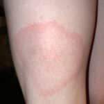 lyme disease rash leg