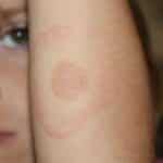 lyme-disease-rash-on-arm