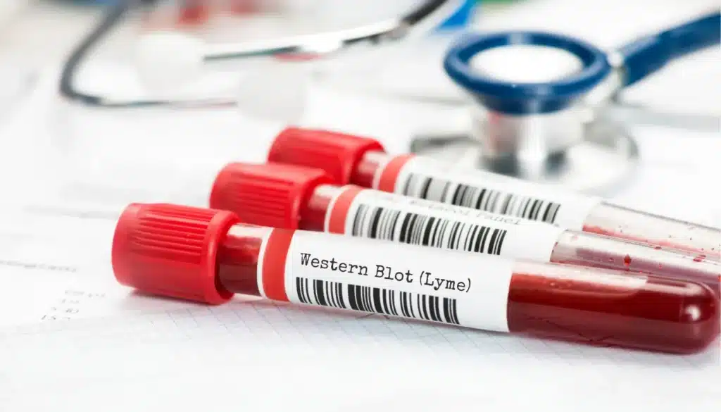 Western Blot Lyme Test