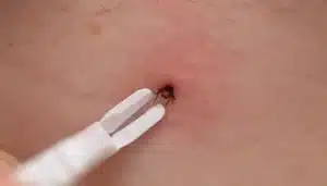 lyme disease prevention after tick bite featured image