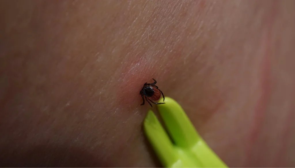 tick bite symptoms