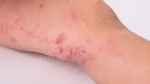 lyme disease vs lupus