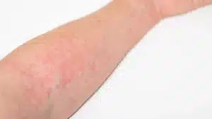 red flush and hives on the forearm
